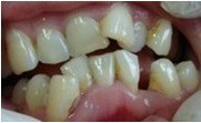 比较常见的畸形牙有牙齿排列不齐,上牙前突,下巴前翘,嘴巴歪偏等等.