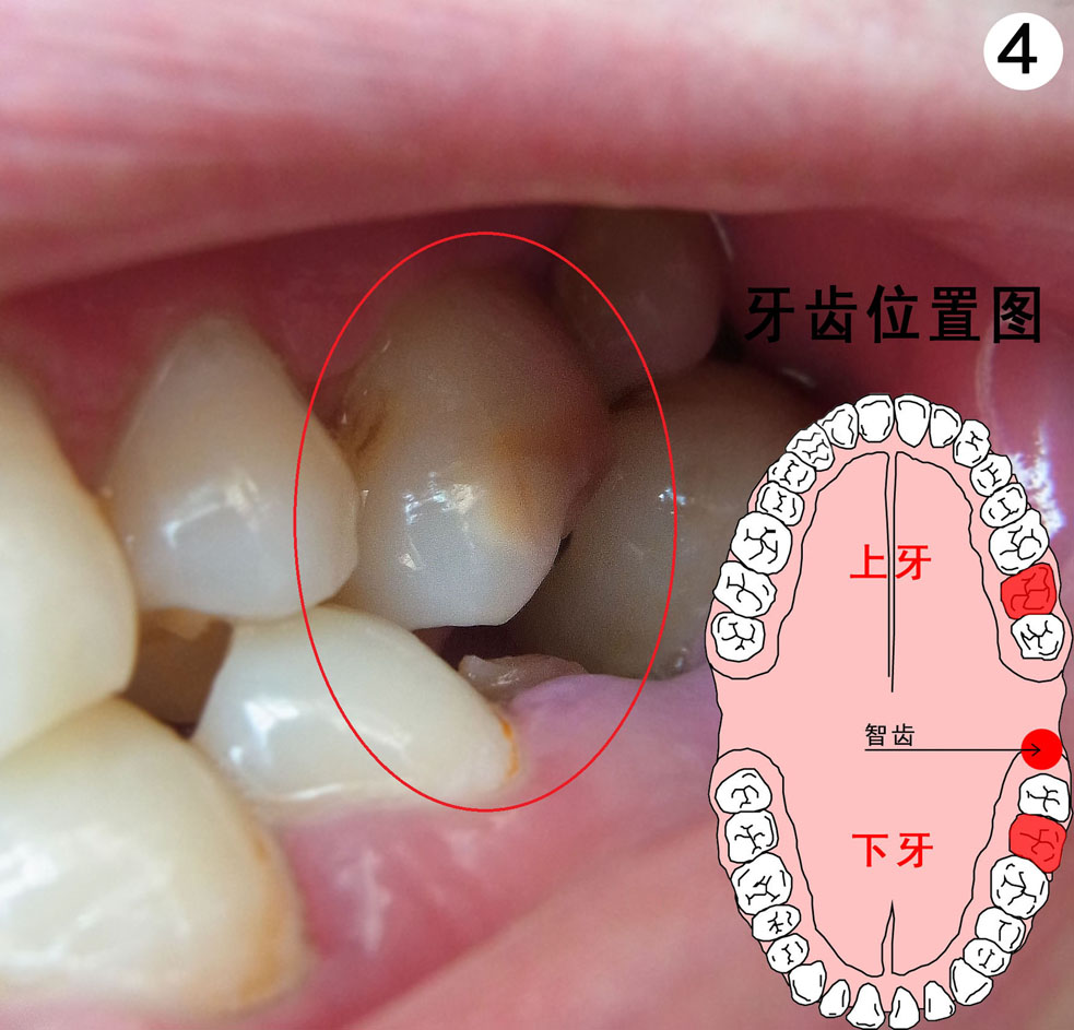 智齿可以拔吗