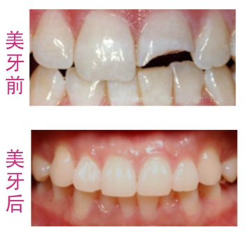 牙齿缺损修复什么方法比较好